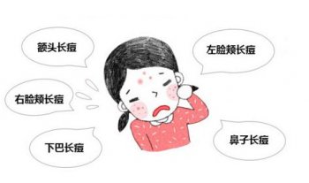 脸上有暗疮怎么办
